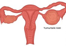 yumurtalık kist