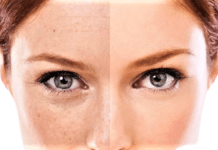 Kimyasal Peeling Nedir? Nasıl Yapılır? kimyasal peeling