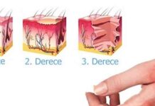 Yanık Dereceleri Ve Türleri Nelerdir? yanık derecesi
