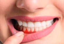 En Çok Karşılaşılan Diş Problemleri Nelerdir? diş eti